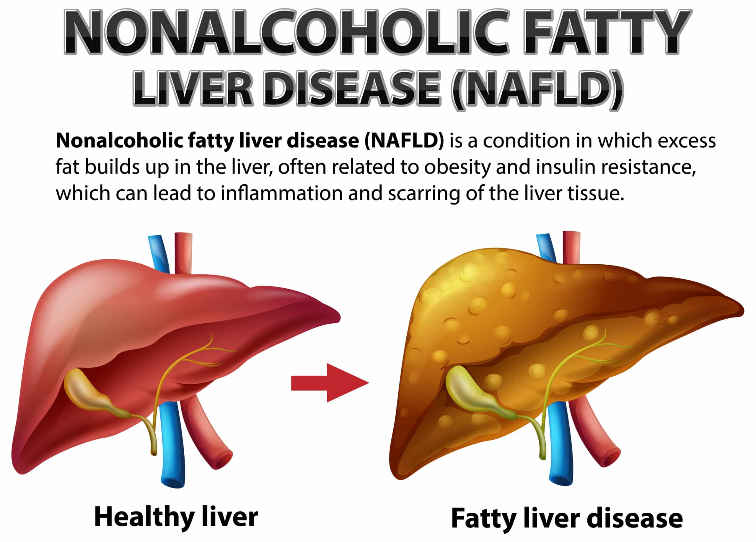 choline liver fatty liver disease